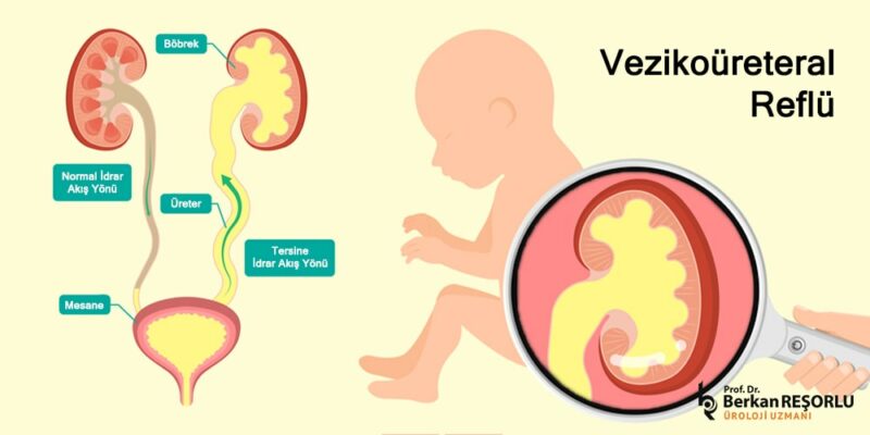 Vezikoureteral-Reflu-bobrek-kacagi-tedavisi