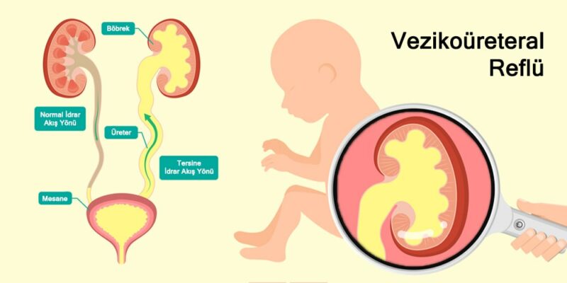 Vezikoureteral-Reflu-bobrek-kacagi-tedavisi-logosuz